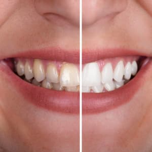 Teeth Whitening Online Training Course ONLY $60