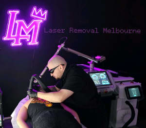 Tattoo laser removal 