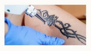 Laser Tattoo Removal - Xora Health